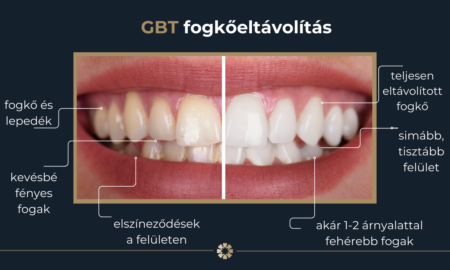 Irányított biofilm terápia előtt és után képek infografika.