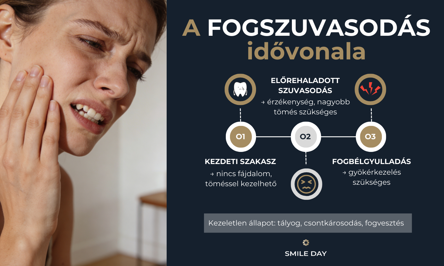 Infografika a fogszuvasodás előrehaladásáról a kezdeti elváltozástól a gyökérkezelésig és a kezeletlen állapot következményeiig.