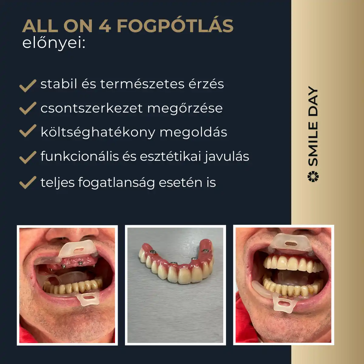 Az all-on-4 fogpótlás előnyei.