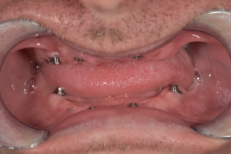 All-on-4 implantátum előtt.