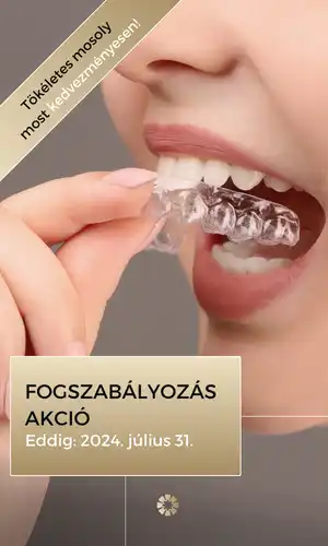 Láthatatlan fogszabályozó akcióval.