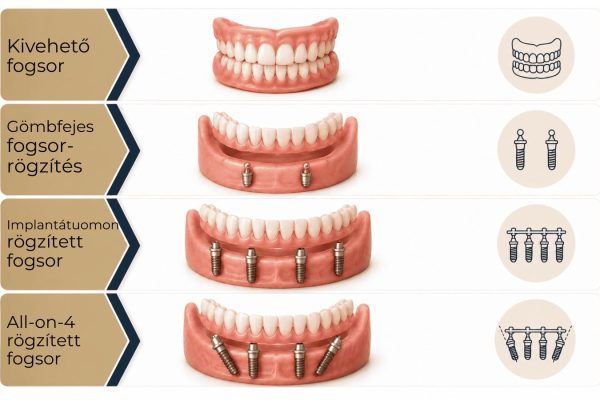 all-on-4-fogpotlasi-lehetosegek-smile-day-clinic-infografika